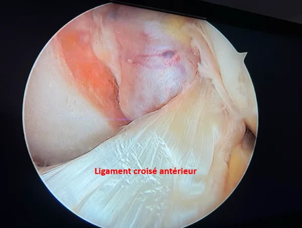 Vue arthroscopique du ligament croisé antérieur reconstruit