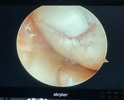 Cartilage abîmé (arthroscopie)