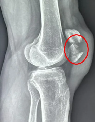 Fracture de la rotule