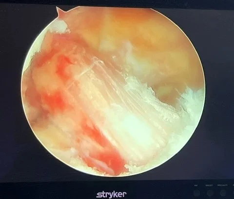 Greffon Kenneth Jones en place (arthroscopie)