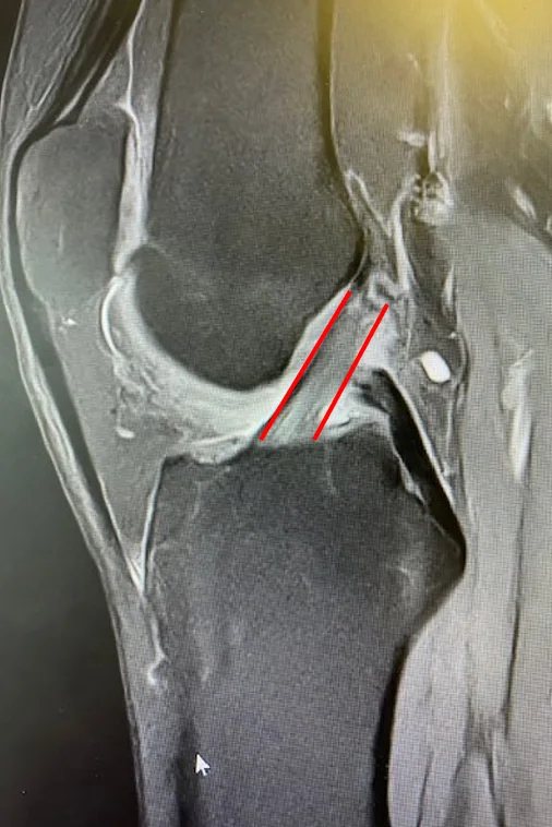 IRM du genou montrant un ligament croisé antérieur normal