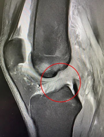 IRM montrant une rupture du ligament croisé antérieur