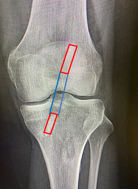Ligamentoplastie Kenneth Jones — radiographie de face post-opératoire