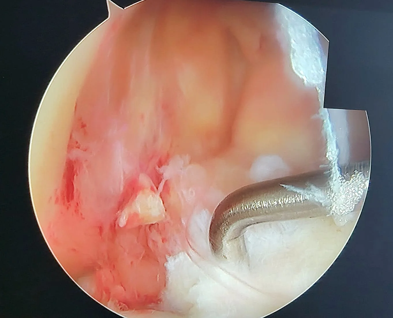 Moignon du LCA rompu vu en arthroscopie