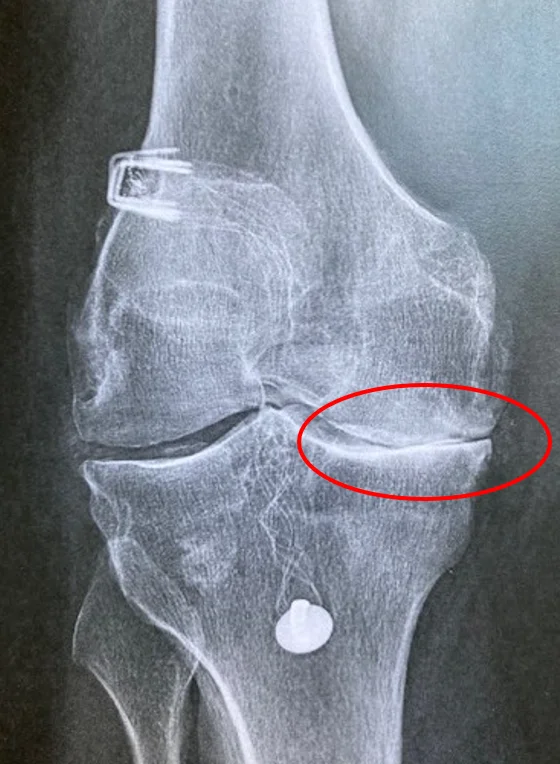 Radiographie d'une gonarthrose avec pincement de l'interligne