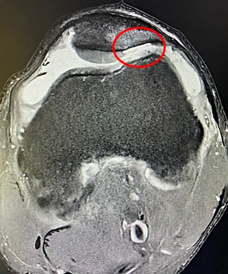 Lésion (scalp) du cartilage rotulien
