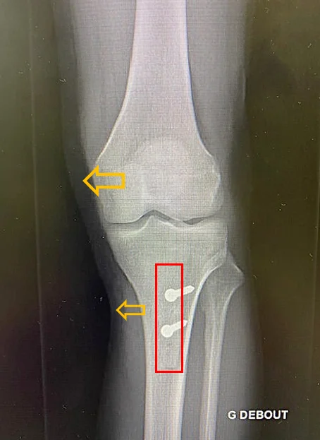 Radiographie de face après TTA