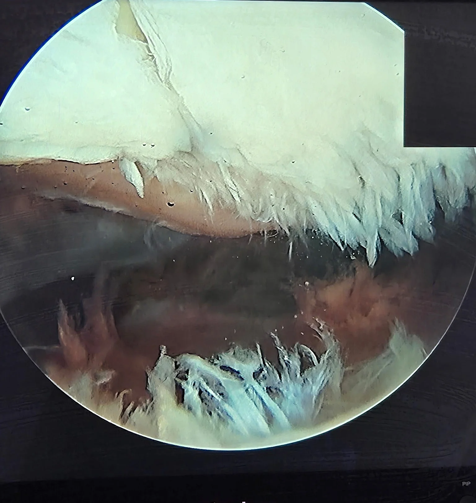 Usure du cartilage rotulien